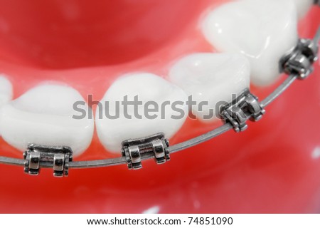 Dental braces macro