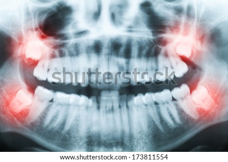 Closeup of x-ray image of teeth and mouth with all four molars vertically impacted. Filled cavities visible. Impacted wisdom teeth (number 8) on the right side of the face (image left) shown red.