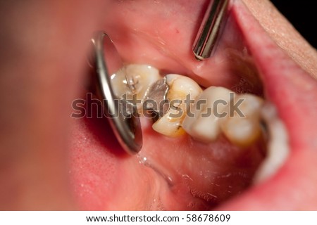 Broken Tooth, Lower Left Molar, Disto-Lingual Cusp Fracture