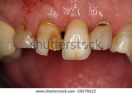 Broken Tooth, Upper Right Central Incisor, Frontal View