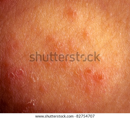 eczema atopic dermatitis symptom skin detail texture