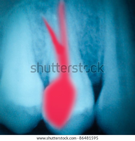 dental tooth x-ray film of root canal therapy