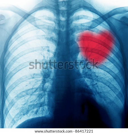 Similar – Foto Bild Röntgenrotes Herz des Menschen (Herzkrankheit)