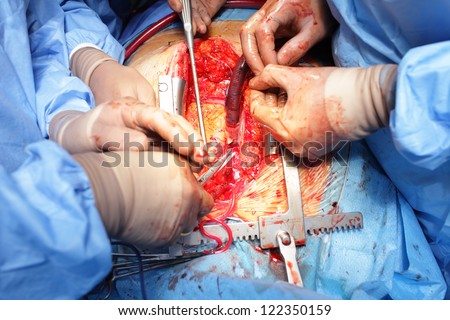 heart surgery. Visible the heart,  hands of cardiac surgeons with tools.
