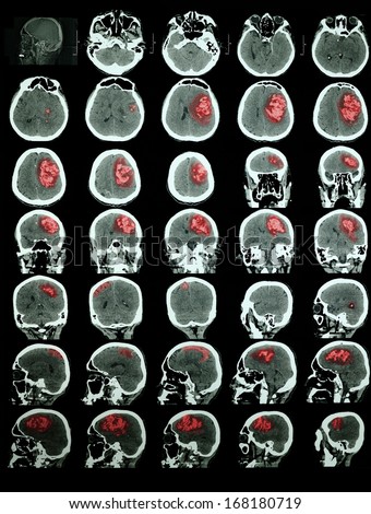 CT of the brain with hemorrhagic stroke. Professional training information. Red is highlighted the affected area