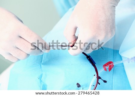 Blood catheter fixed by doctor