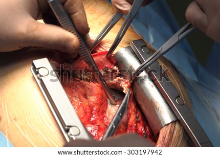 Heart surgery. Hands of the surgeon during the operation macro