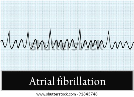 Atrial Fibrillation Vector. Professional Information - 91843748 ...