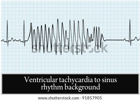 Paroxysm Of Ventricular Tachycardia In Sinus Rhythm Background. Vector ...