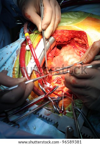 Coronary artery bypass surgery. anastomosis between internal thoracic artery and the coronary artery. Cardiosurgical operation.