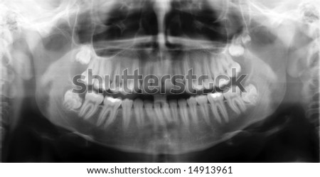 X-ray picture to jaws of the person