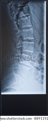 Back X-ray side view showing the spine. Female.