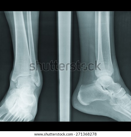 X-Ray radilogy image of injured woman legs