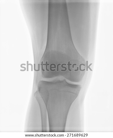 X-ray radiology scanned image of young boy knee injury