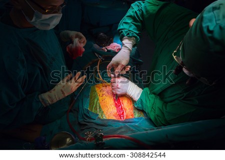 BANGKOK,Thailand-march:31, 2015:The doctor and staff are treating with open heart cardiac bypass surgery in full operation room