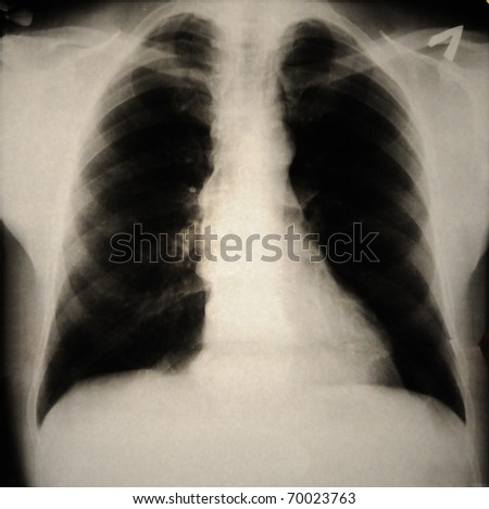 Human Chest With Forestier'S Disease On X-Ray Stock Photo 70023763 ...