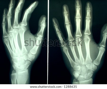 A pair of hands X-rayed
