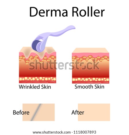 Mesorolling process and cell structure, before after effect