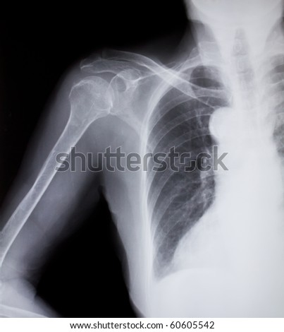 X-Ray Of Human Shoulder Stock Photo 60605542 : Shutterstock