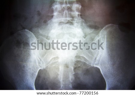 X-ray of the pelvis and spinal column of a woman
