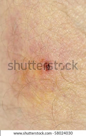 infected tick bite on thigh