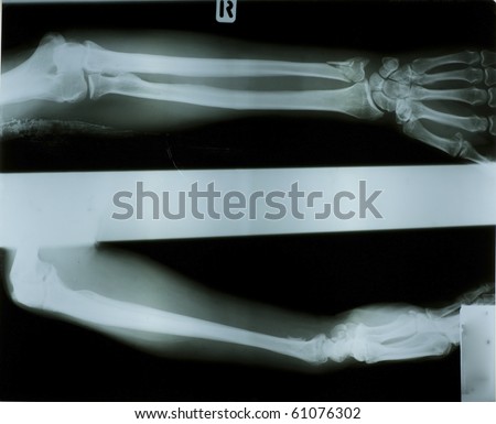 Photos and lower arm bone joint.