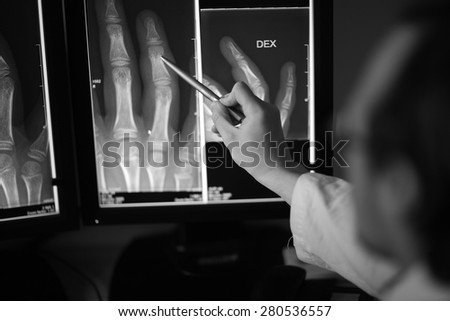 Radiologist  pointing anomaly on the patient hand x-ray