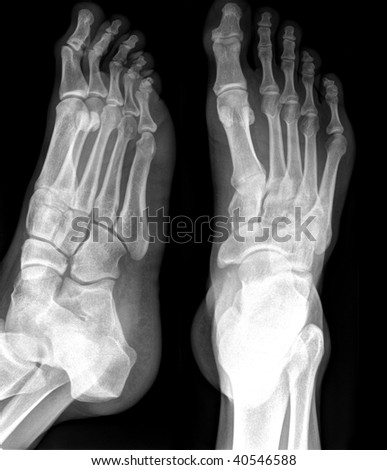 X-Ray Of Foot Stock Photo 40546588 : Shutterstock