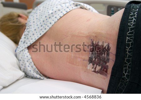 Patient on her side after back surgery in hospital bed about to have surgical wound dressed.