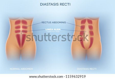 Diastasis Recti also known as Diastasis Rectus Abdominus or abdominal separation, it is common among pregnant women and post birth. There is a gap between the rectus abdominis muscles.