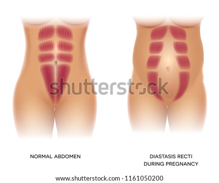 Diastasis Recti during pregnancy, also known as Diastasis Rectus Abdominus or abdominal separation, it is common among pregnant women and post birth. There is a gap between muscles.