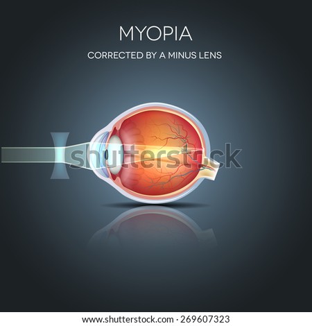 Myopia corrected by a minus lens. Myopia is being short sighted (near sighted). Far away object seems blurry. 