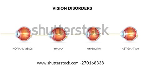 myopia hyperopia kép