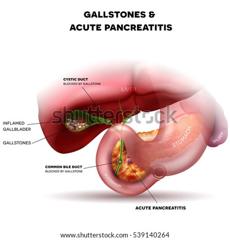 gallbladder pain symptoms images - usseek.com gall stone pain diagram 