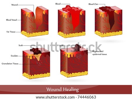 Wound Healing. Illustration Showing Skin After Injury, Appears Blood ...