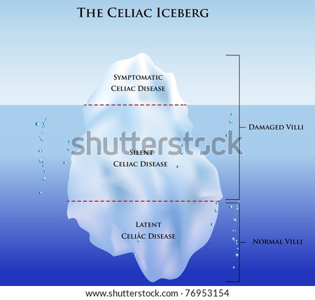 Celiac disease Iceberg. Symptomatic, Silent and Latent celiac disease.