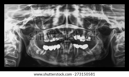 Medical X ray imaging of human teeth