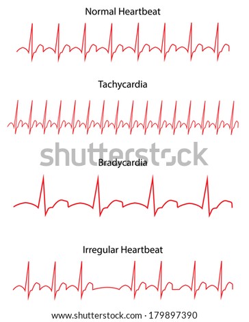 ECG Traces of Normal and Diseases