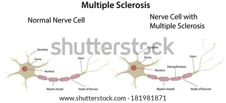 Multiple Sclerosis Labeled Diagram