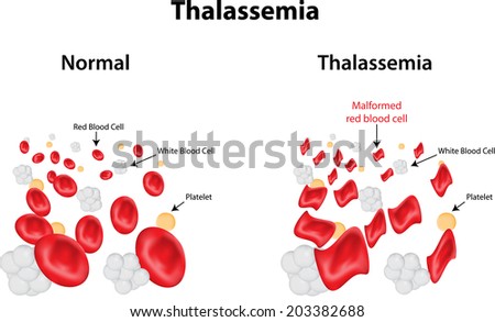 Thalassaemia labeled Diagram