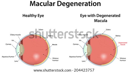 Macular Degeneration