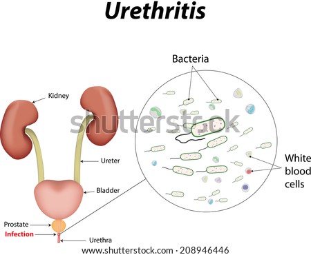 Urethritis