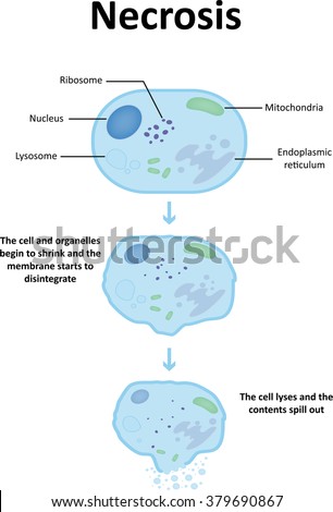 Necrosis Diagram Stock Vector Illustration 379690867 : Shutterstock