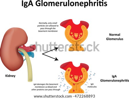 IgA Glomerulonephritis Illustration