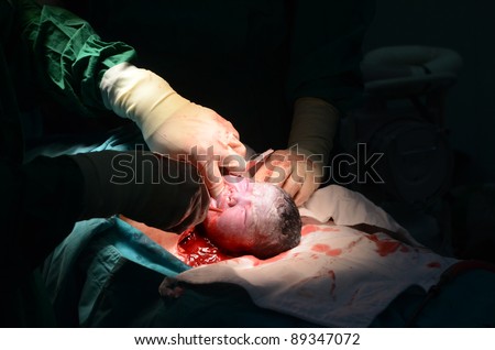 New baby being born during cesarean section