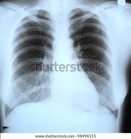 Roentgen Shot Of Lungs Stock Photo 98496515 : Shutterstock