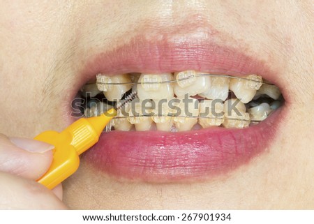 Close up crooked teeth with braces, interdental brushing