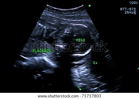 Ultrasound scan baby (placenta & head)