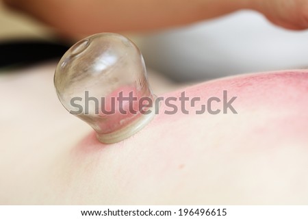 to cup sb, therapist removing a fire cupping glass from the back of a young woman fire cupping treatment