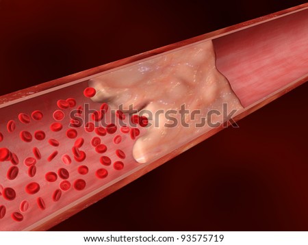 Blood Clot, Calcified Lesion, Plaque Obstructing Blood Flow Stock Photo ...